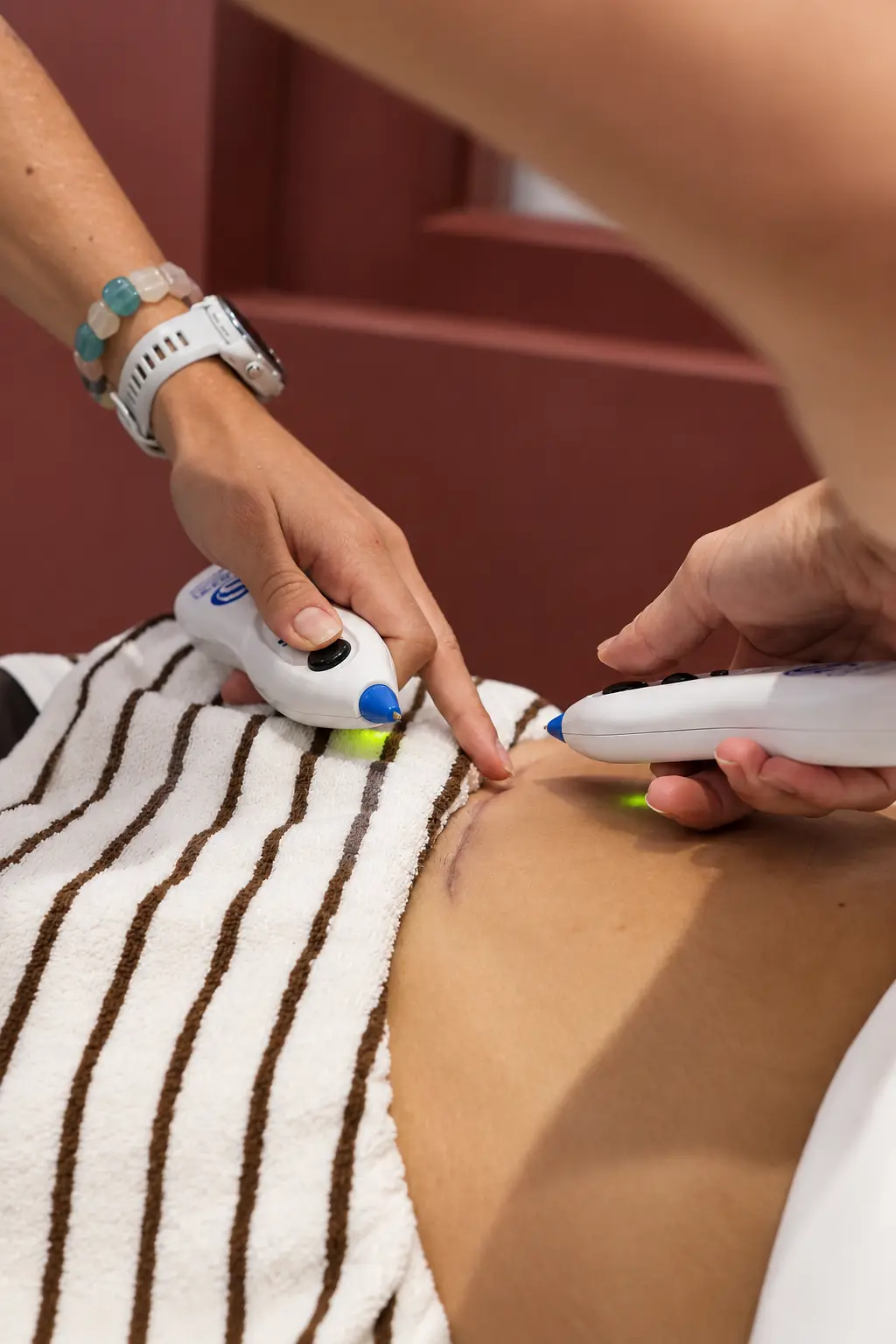 Laser therapy treatment on a C-section scar